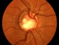 /album/fotogaleria-inicio/glaucoma-jpg1/
