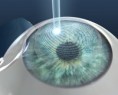/album/fotogaleria-inicio/lasik-jpg1/